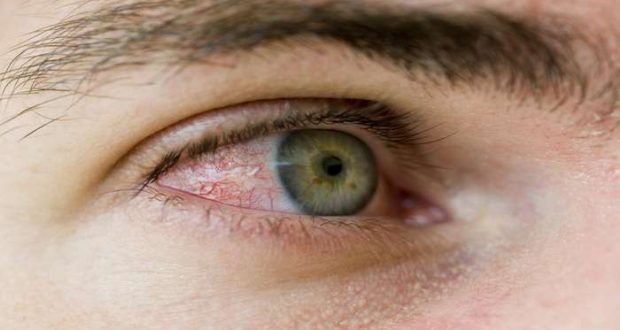 Alergias oculares afetam 20 por cento da população