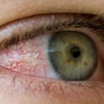 Nova técnica reduz pressão intraocular no glaucoma