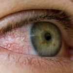 O Glaucoma é a principal causa de cegueira irreversível