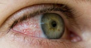 Alerta para aumento de problemas oculares no verão
