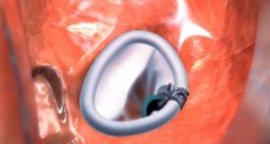 Cardiologia de Gaia inova com novas técnicas cirúrgicas