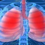 Campanha de sensibilização da Hipertensão Pulmonar