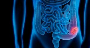 Centro do Cancro do Reto do CHUA lança website