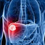 Doença Hepática Alcoólica