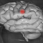 Portugueses desenvolvem tratamento do AVC isquémico