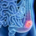 Aumento de diagnósticos do Cancro Colorretal abaixo dos 50 anos