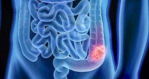 Aumento de diagnósticos do Cancro Colorretal abaixo dos 50 anos